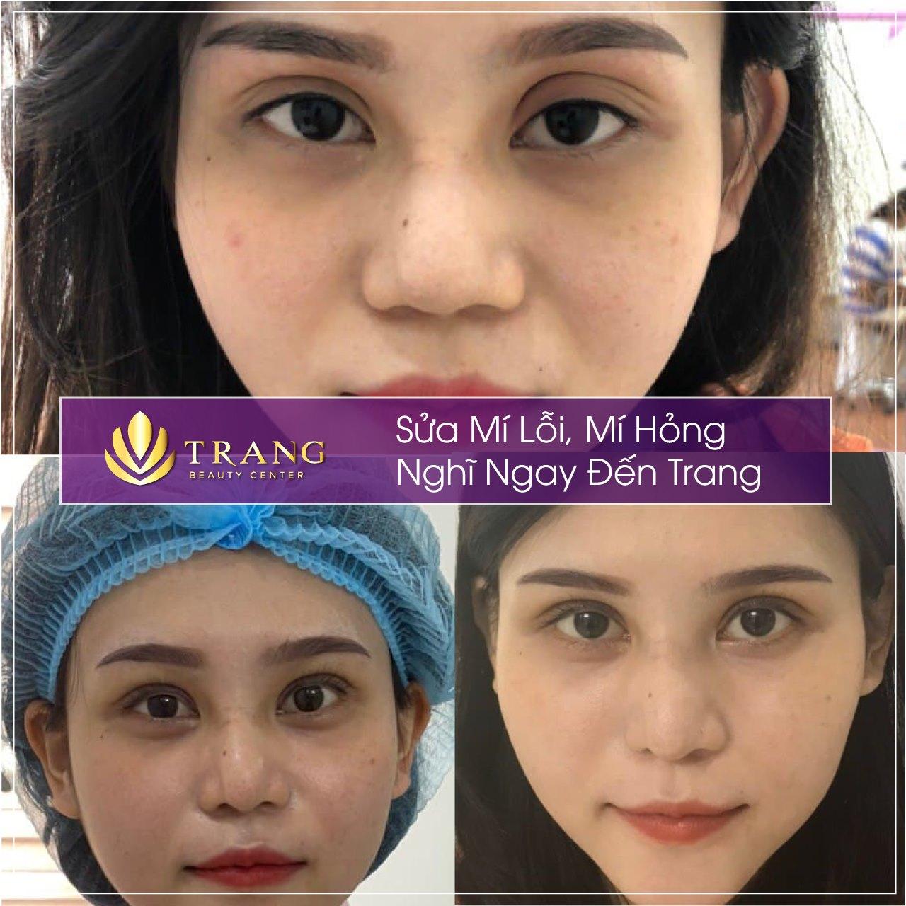 5 Địa Chỉ Sửa Mí Mắt Hỏng Đáng Tin Cậy Nhất Tại TP.HCM