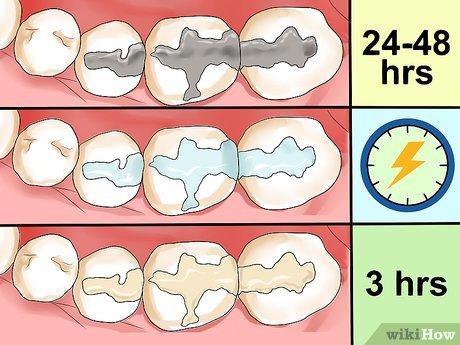 Cách Chăm sóc răng sau khi trám hiệu quả