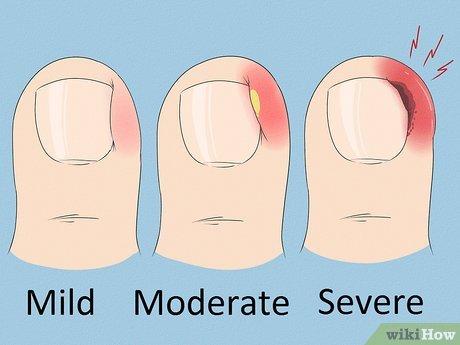 Móng quặp có tự khỏi không? Những câu hỏi thường gặp và giải đáp chi tiết