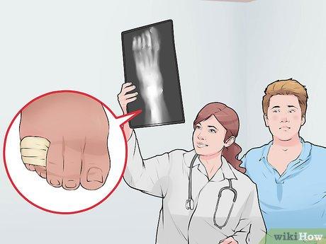 Hướng dẫn băng bó ngón chân út khi bị gãy