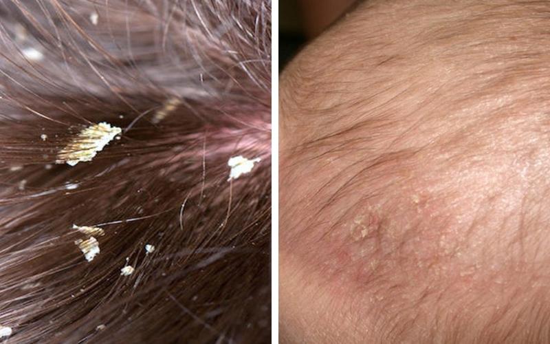 Làm thế nào để chọn dầu gội trị gàu hiệu quả cho bé yêu