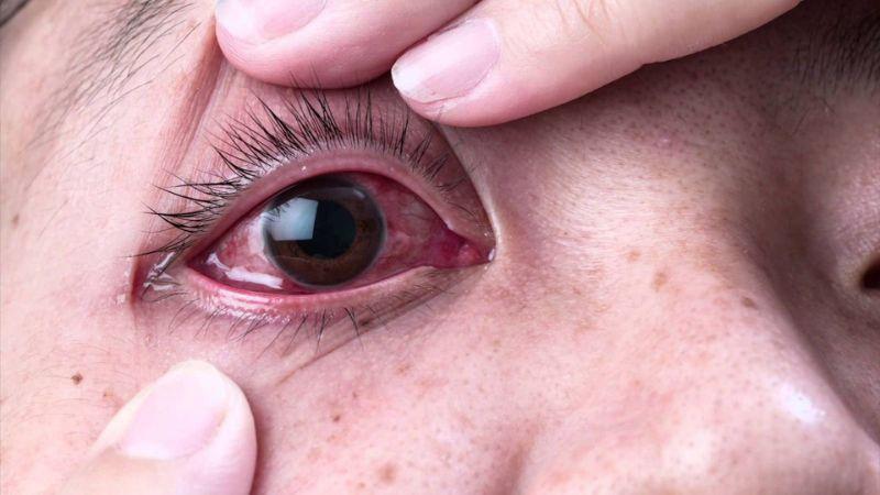 Nguyên nhân và dấu hiệu nhận biết đau mắt đỏ ở trẻ em cùng những cách chăm sóc hiệu quả