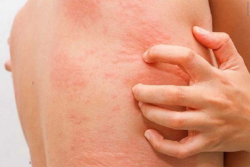 Dị ứng thời tiết: Dấu hiệu nhận biết và biện pháp sơ cứu hiệu quả