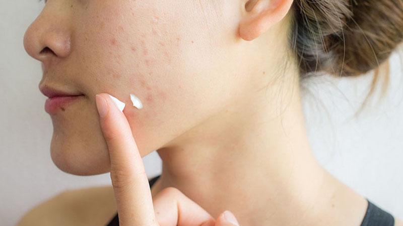 Sữa rửa mặt nào là sự lựa chọn lý tưởng cho da dầu và mụn?