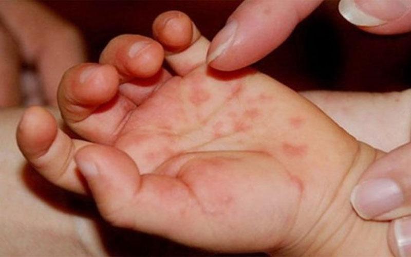 Trẻ bị tay chân miệng cần được bổ sung những thực phẩm giúp tăng cường sức đề kháng và hỗ trợ quá trình phục hồi nhanh chóng.