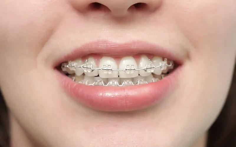 Niềng răng mắc cài pha lê: Phương pháp có thật sự hiệu quả? Những điểm mạnh và điểm yếu