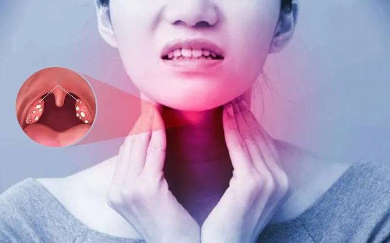 Thực đơn cho người bị viêm amidan giúp giảm sưng tấy và đau rát cổ họng