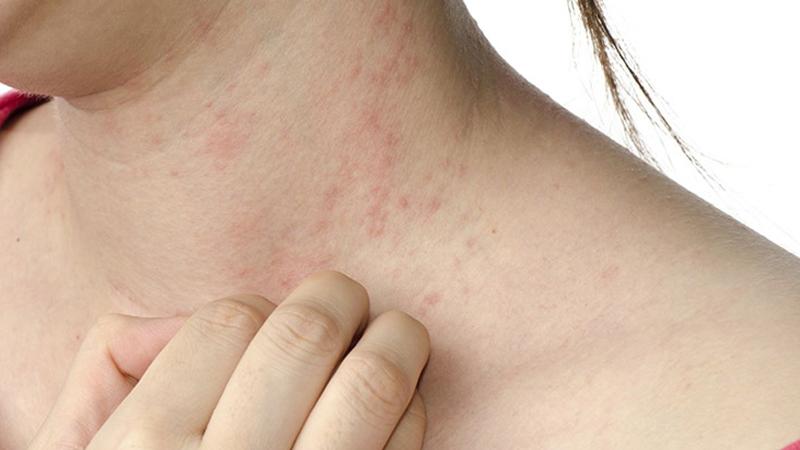 Nguyên nhân gây mẩn ngứa và các biện pháp phòng ngừa hiệu quả