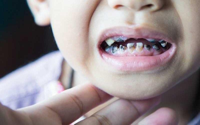 Khi trẻ gặp phải tình trạng sún răng sữa, cha mẹ nên làm gì để bảo vệ sức khỏe răng miệng cho bé? Hãy tìm hiểu các biện pháp phòng ngừa sún răng sữa hiệu quả để giúp bé yêu có nụ cười khỏe mạnh và tự tin.