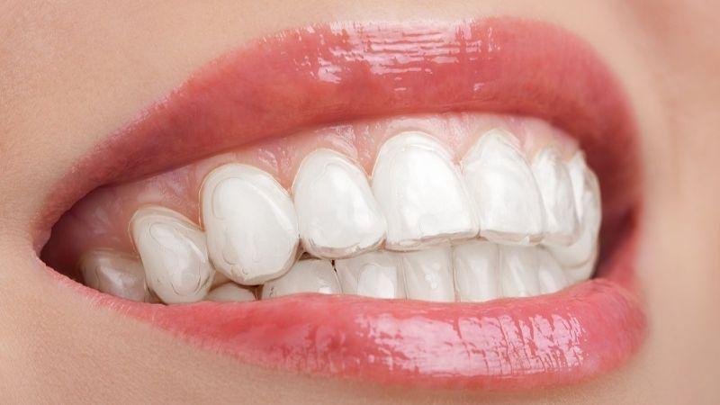Sau khi tẩy trắng răng, bạn nên lựa chọn thực phẩm nào để duy trì sự trắng sáng và sức khỏe cho răng?