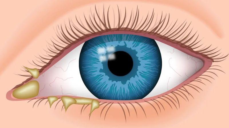 Mắt đổ ghèn là hiện tượng khá phổ biến mà bất kỳ ai cũng có thể gặp phải. Nhưng bạn đã thật sự hiểu về nguyên nhân, dấu hiệu và cách phòng ngừa tình trạng này chưa? Cùng khám phá những thông tin cần thiết để bảo vệ sức khỏe đôi mắt của bạn.