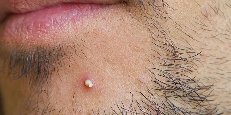Những thực phẩm hỗ trợ điều trị mụn đầu trắng hiệu quả tại nhà