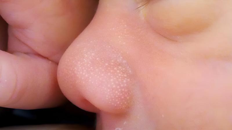 Mụn hạt kê ở trẻ sơ sinh là hiện tượng phổ biến mà nhiều cha mẹ gặp phải. Vậy mụn hạt kê là gì và làm thế nào để xử lý đúng cách? Cùng khám phá chi tiết trong bài viết này.
