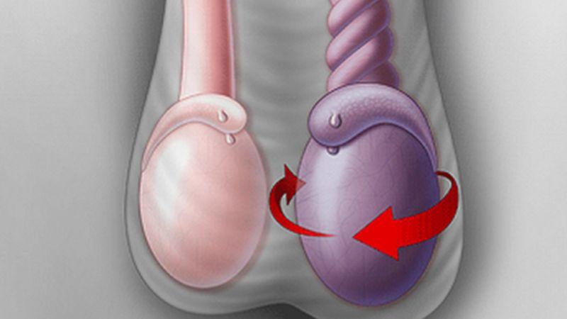 Hiện tượng tinh hoàn lệch kích cỡ ở trẻ sơ sinh là gì?