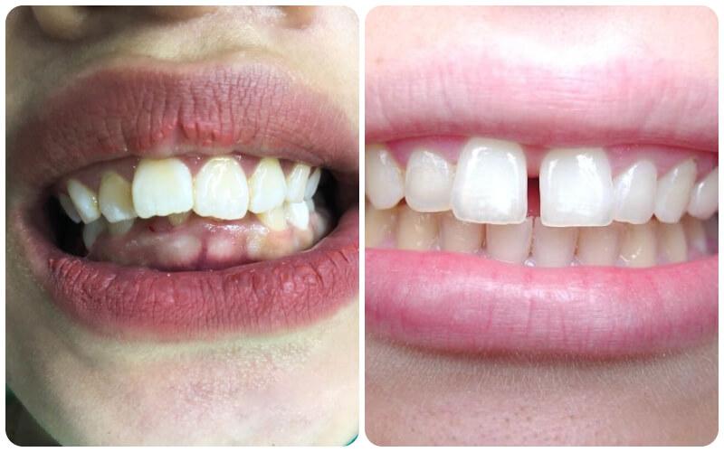 Răng cửa lệch lạc: Nguyên nhân và phương pháp cải thiện hiệu quả.