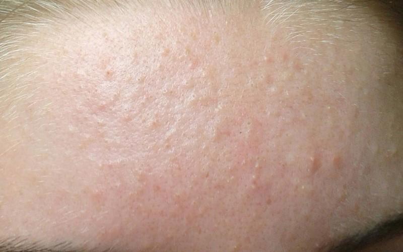 Mụn ẩn là gì? 5 cách trị mụn ẩn dưới da hiệu quả và dễ thực hiện