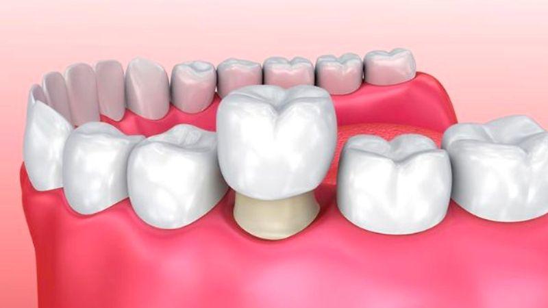 Có thể bọc răng sứ cho một chiếc răng duy nhất không? Và chi phí bọc răng sứ cho một chiếc răng là bao nhiêu?