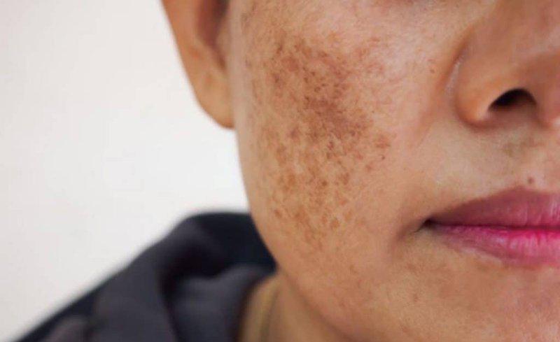 Khám phá các phương pháp trị nám hiệu quả hàng đầu hiện nay