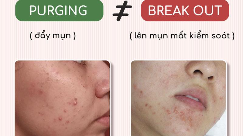 Làm sao để chăm sóc da khi đang trải qua giai đoạn 'purging' và 'break out'?