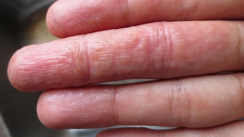 Tìm hiểu bệnh tổ đỉa: Nguyên nhân và phương pháp điều trị hiệu quả