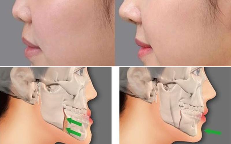 Những sai lầm cần tránh khi áp dụng phương pháp Mewing