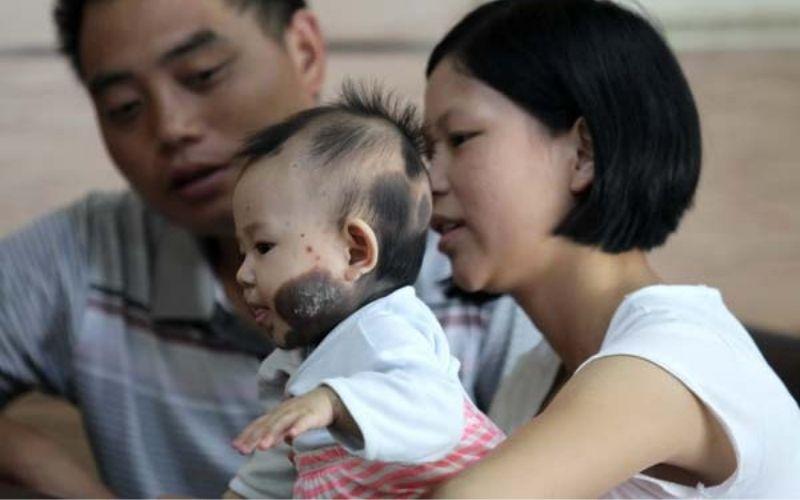 Phương pháp ngăn ngừa vết bớt - chàm cho bé ngay từ khi còn trong bụng mẹ