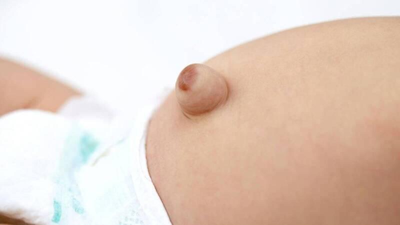 Thoát vị rốn ở trẻ là gì và khi nào cần phải phẫu thuật? Đây là một câu hỏi mà nhiều bậc phụ huynh cần phải nắm rõ để có thể xử lý kịp thời khi trẻ gặp phải tình trạng này.