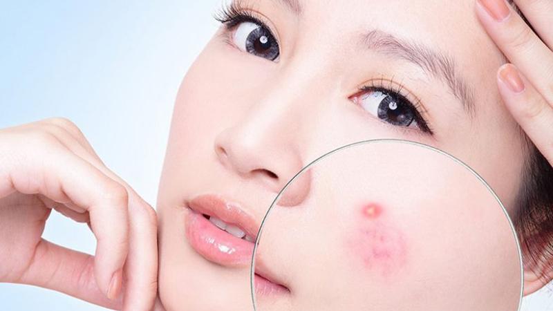 Khám phá 10 loại sữa rửa mặt trị mụn hiệu quả, đang làm mưa làm gió trên thị trường mà bạn không thể bỏ qua.