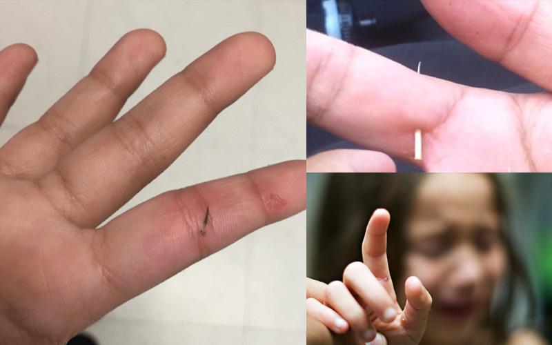 8 phương pháp đơn giản giúp lấy dằm khỏi tay mà không đau, hiệu quả và nhanh chóng