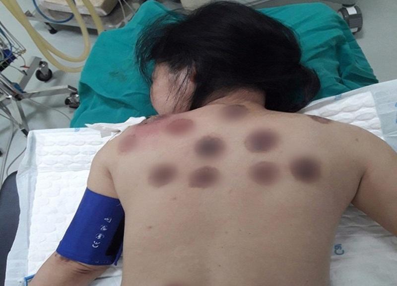 Giữa những tranh cãi về giác hơi, liệu phương pháp này thực sự mang lại hiệu quả và an toàn như chúng ta vẫn nghĩ?