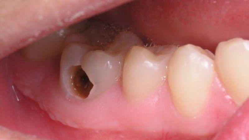Khi bị sâu răng, bạn nên làm gì? Dưới đây là 11 phương pháp hiệu quả để chữa trị và ngăn ngừa sâu răng, giúp bạn bảo vệ sức khỏe răng miệng tốt nhất.