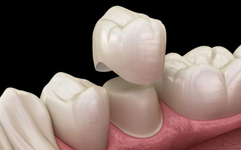 Mão răng sứ là gì? Những loại mão răng sứ phổ biến hiện nay
