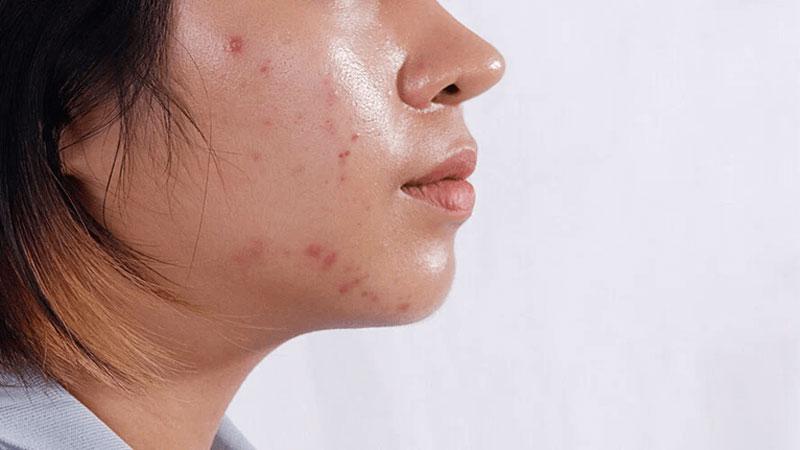 Các bước chăm sóc da mụn hiệu quả, phương pháp mang lại làn da mịn màng cho bạn