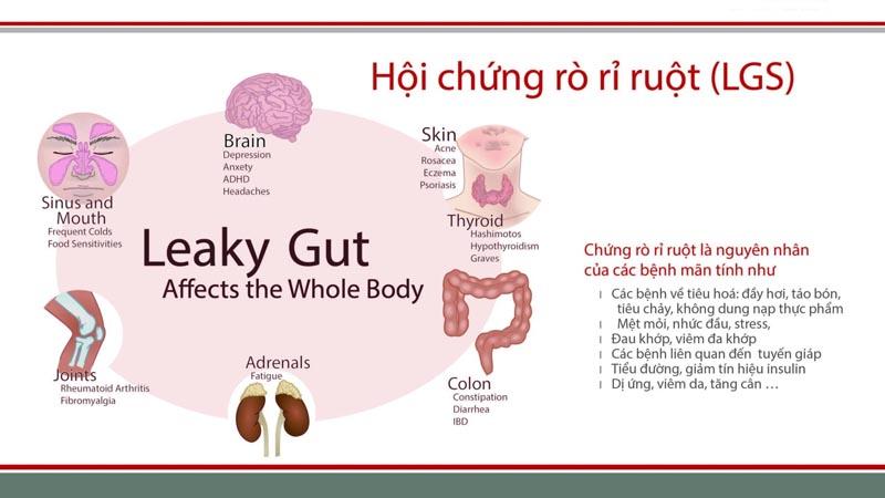 Hội chứng rò rỉ ruột là gì? Và chế độ ăn phù hợp cho người mắc hội chứng này như thế nào?