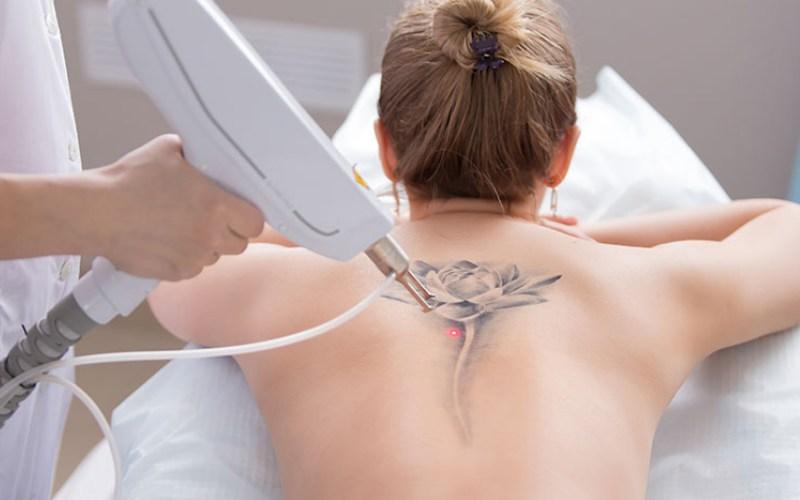 Xóa hình xăm có gây đau đớn không? Khám phá hơn 5 cách loại bỏ hình xăm tại nhà hiệu quả.