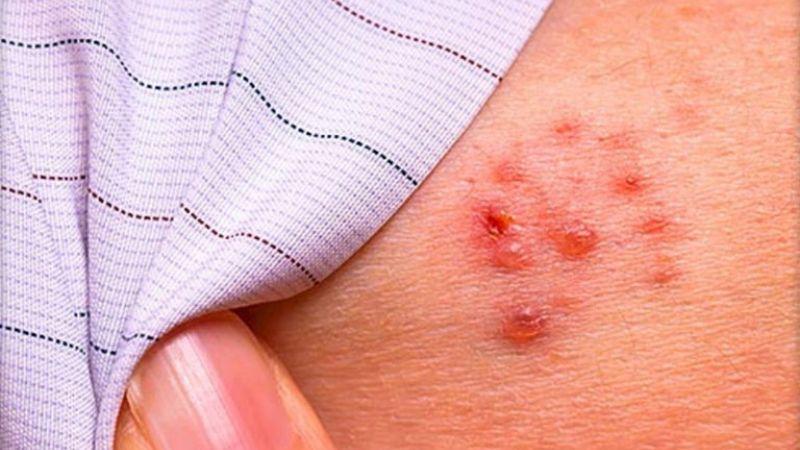 Bệnh zona ở trẻ em: Dấu hiệu và cách nhận diện chính xác