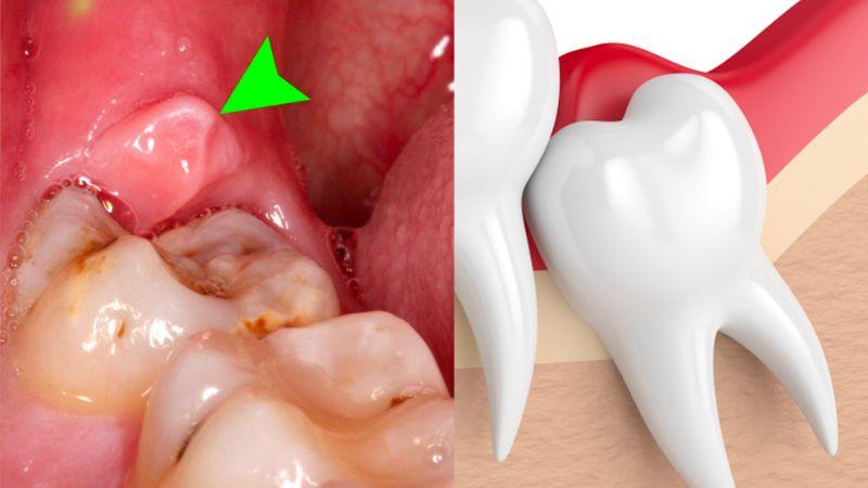 Lợi trùm răng khôn là gì? Các dấu hiệu nhận biết viêm lợi trùm khi mọc răng khôn