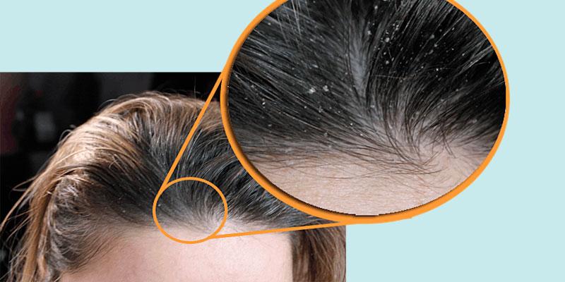 Vì sao da đầu lại dễ bị gàu hơn vào mùa đông?