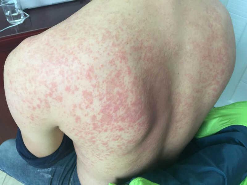 Tại sao bạn lại bị dị ứng với bia?