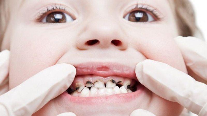 Tại sao răng của trẻ lại bị đen sau khi uống sắt nước?