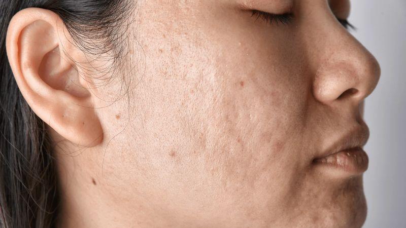 Sẹo lõm là gì và cách điều trị hiệu quả hiện nay? Khám phá những phương pháp an toàn giúp cải thiện làn da và lấy lại vẻ mịn màng.