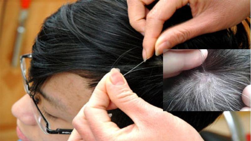 Nguyên nhân và cách điều trị tình trạng tóc bạc sớm ở trẻ em
