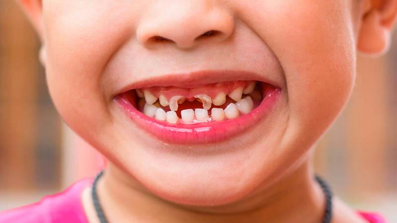 Răng sữa của trẻ bị mòn và mủn, cha mẹ cần phải làm gì để bảo vệ và chăm sóc tốt cho sức khỏe răng miệng của bé?