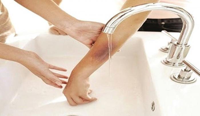 Cách chữa bỏng tại nhà giúp giảm đau tức thì