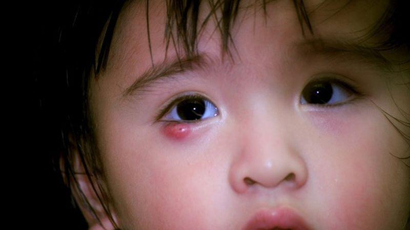 Những nguyên nhân gây viêm bờ mi mắt ở trẻ và cách chăm sóc hiệu quả tại nhà để giảm thiểu tình trạng này.