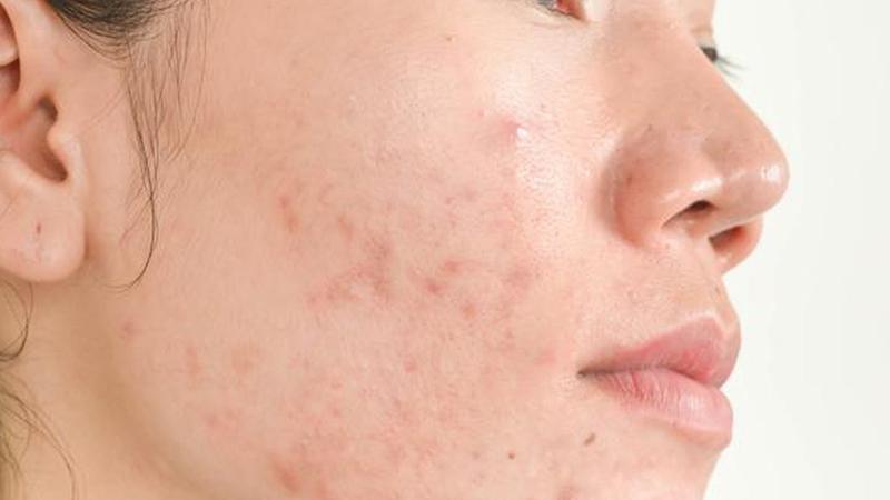 Hãy từ bỏ thói quen nặn mụn bằng tay nếu không muốn làn da bạn ngày càng xấu đi.