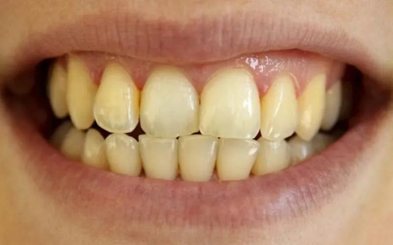 Tại sao dù bạn đánh răng mỗi ngày, răng vẫn bị ố vàng?