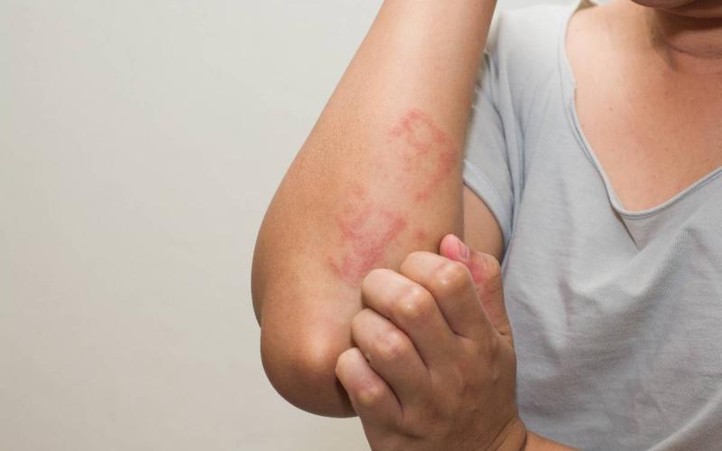 Mề đay sau sinh là gì? Cùng tìm hiểu những triệu chứng điển hình của tình trạng này.