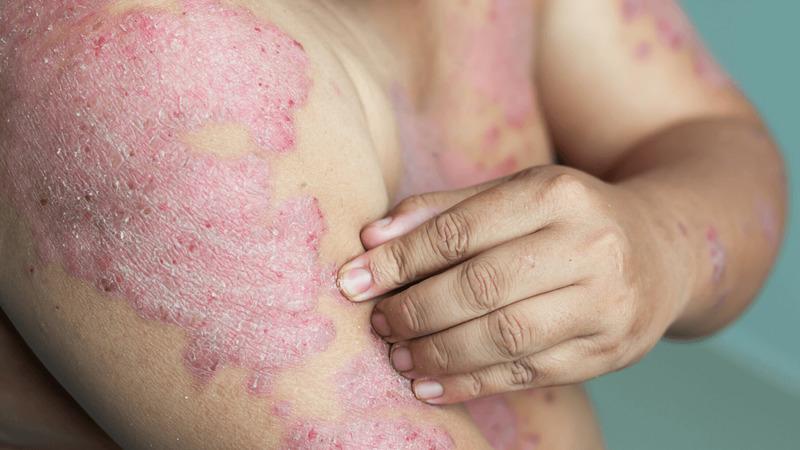 Bệnh hắc lào là gì? Các triệu chứng và phương pháp điều trị hiệu quả