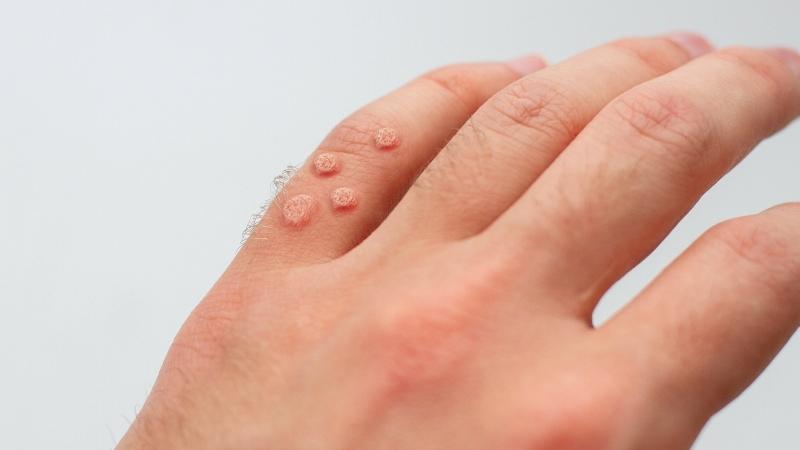 Giải đáp câu hỏi: Liệu bệnh sùi mào gà có thể tự khỏi không?